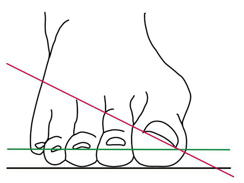 Warnzeichen für einen Hallux valgus: Der Nagel des großen Zehs dreht sich (rote Linie) aus der Idealposition (grüne Linie).  Mit Fortschreiten der Erkrankung werden die anderen Zehen verdrängt.  Grafik: Asklepios Klinikum Bad Abbach