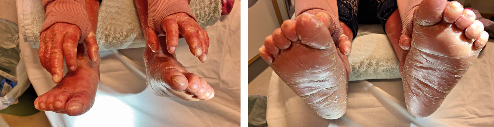 3a+b Siebenjähriger Junge mit Plantarkeratose der Füße sowie dystrophischem Nagelwachstum (trommelschlägelartig). Fotos: Podologie Melanie Roithner