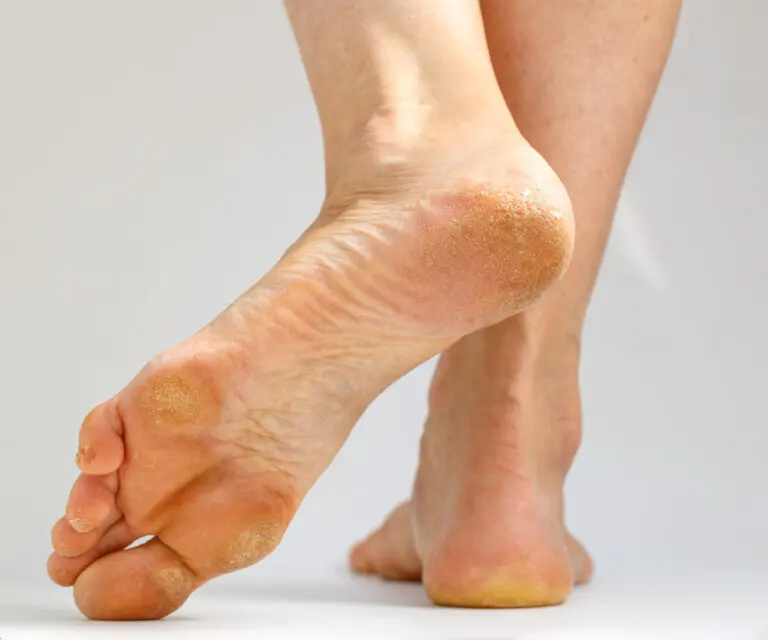 Fußsohle mit Hyperkeratose