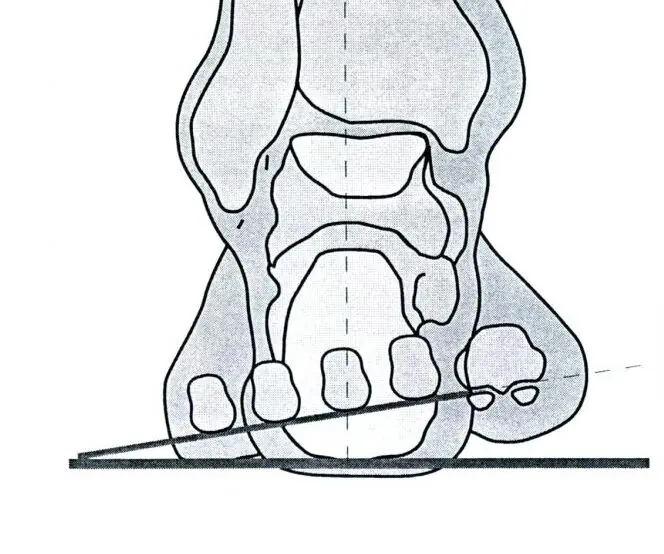 Darstellung einer Vorfuß-varus-Stellung an einer Zeichnung des linken Fußskeletts. Ansicht von hinten (posterior)