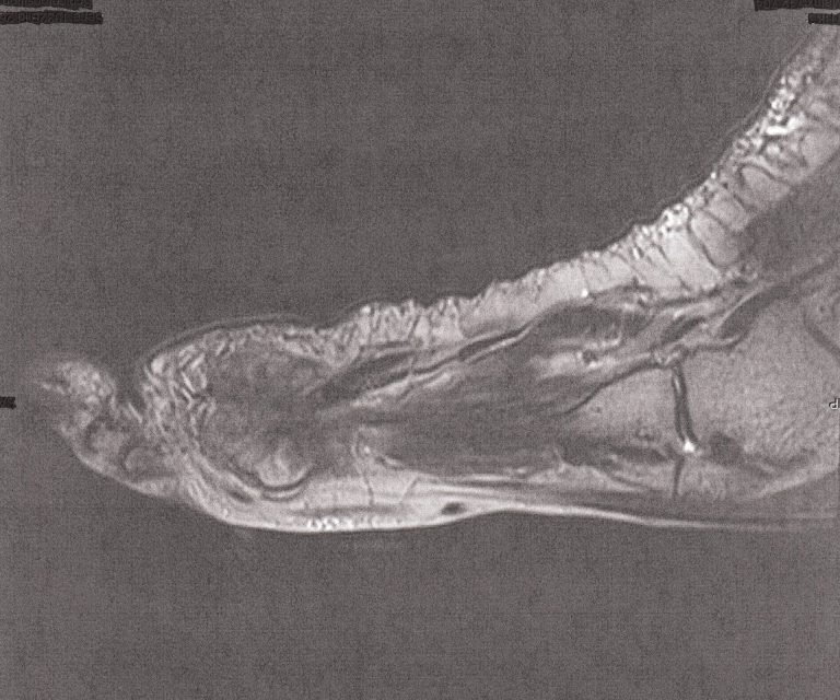 MRT des rechten Fußes seitlich zeigt eine Bursitis intermetatarsale in der Vorfußregion.