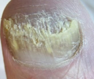 Podologische Behandlungsstrategien bei Nagelmykosen und bakteriellen Infekten der Nagelfalz und des Nagelbetts
