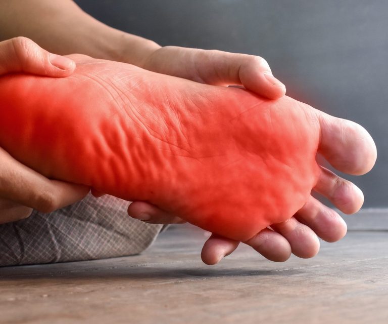Das Burning-Feet-Syndrome kann eine Begleiterscheinung einer Corona-Erkrankung sein.