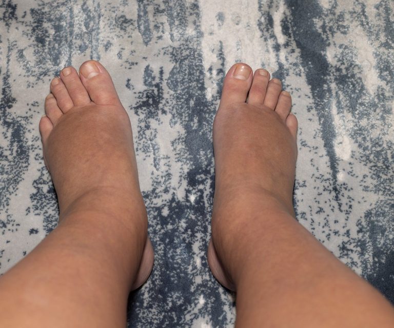 Geschwollene Füße können unterschiedliche Ursachen haben.