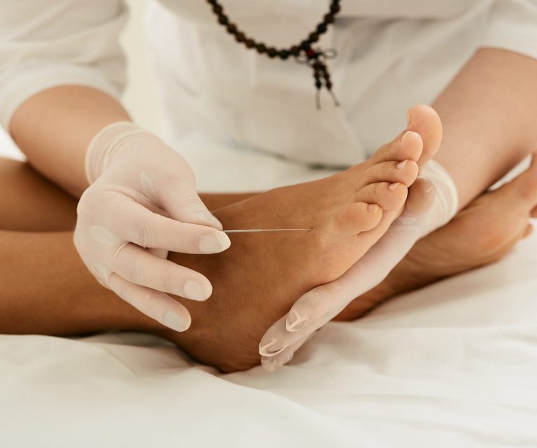 Akupunktur könnte eine neue Therapiemethode beim Diabetischen Fuß werden.